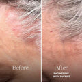 Before and after comparison of skin with 'Showering with Everist' text.